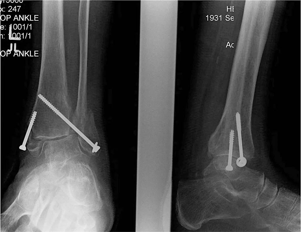 CURRENT CONTROVERSIES IN ANKLE FRACTURE MANAGEMENT at Glasgow Grosvenor Hotel